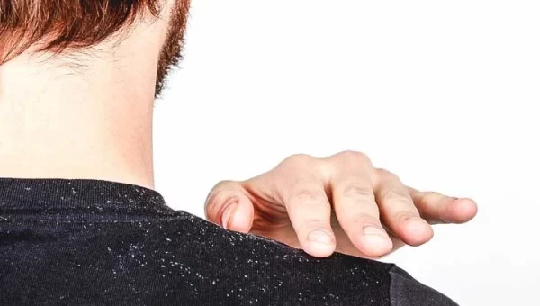 Remove Dandruff With These Best Remedies