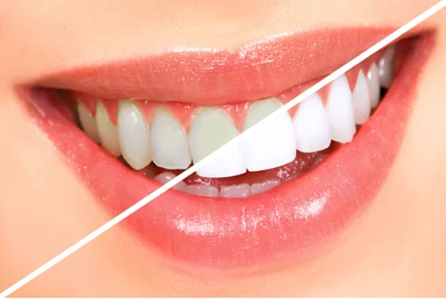 Natural Tips To Remove Yellow Shades In Teeth