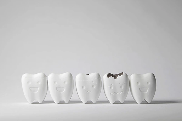 Top Tips To Avoid Dental Cavity Naturally