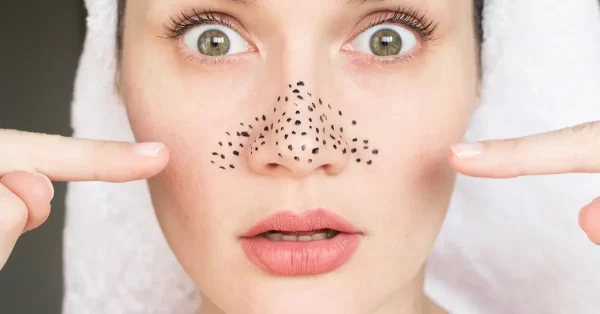 Effective Natural Remedies To Remove Blackheads