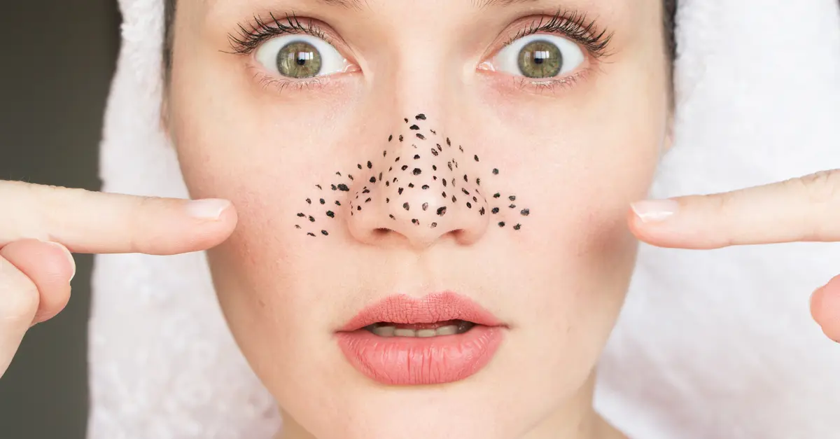 remedies to remove blackheads