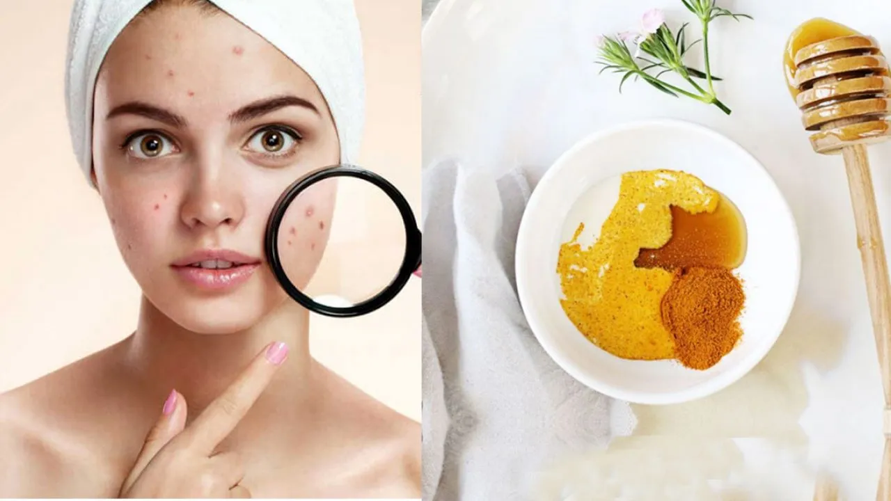 remedies to get rid of pimples