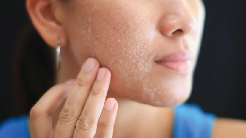 prevent dry skin in winter