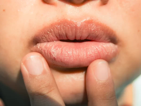 Keep Your Lips Moisturized – How To Get Rid Of Chapped Lips