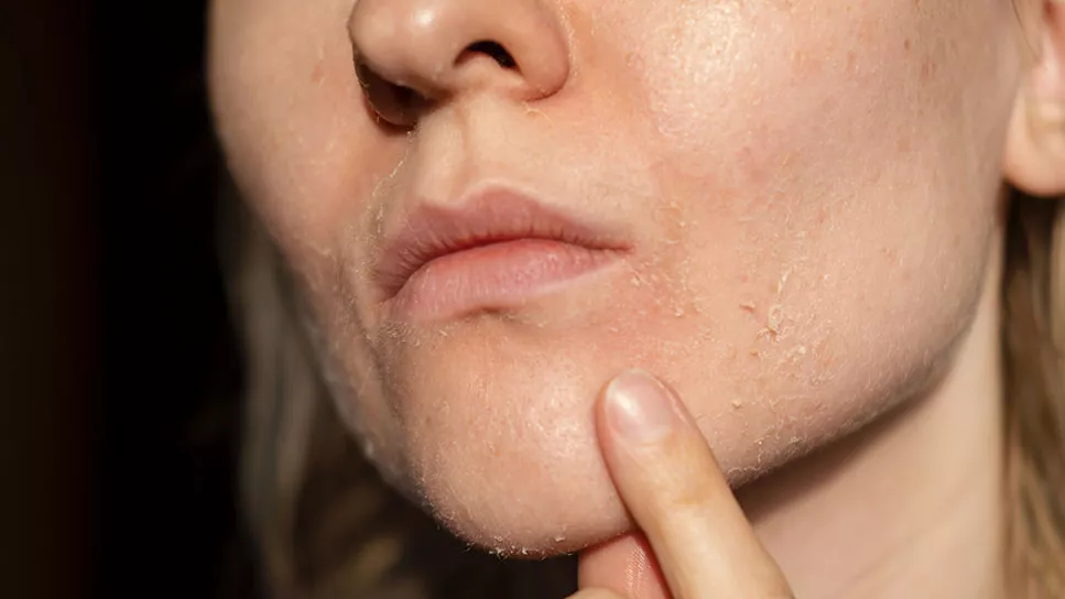 skin dryness in winter